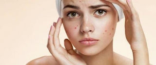 Cómo afecta el acné la autoestima de los adolescentes - Tienda Farmapiel