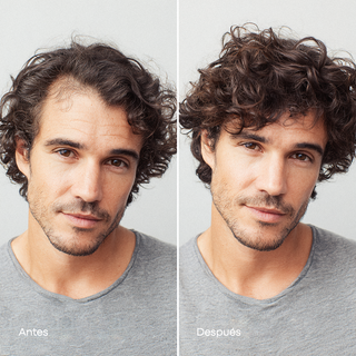 Anacastel Minoxidil 5% - Auxiliar en el Tratamiento Anticaída - 3 unidades - 60ml