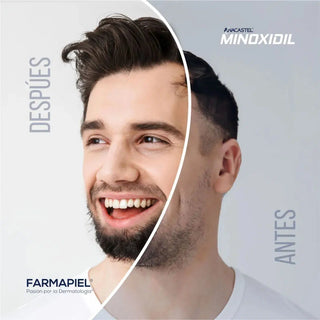 Anacastel - Minoxidil 5% unitario azul - Tratamiento Anticaída - 60ml