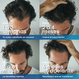 Anacastel Minoxidil 5% | 6 Meses de Tratamiento Anticaída para Cabello y Barba | Presentación Spray 60ml
