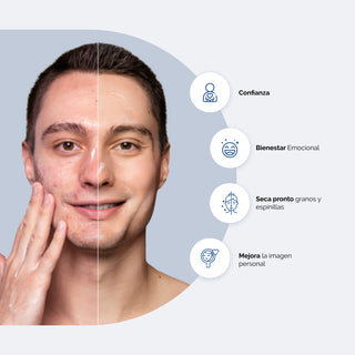 Bpollen Peróxido de Benzoilo Gel 5% - 60g