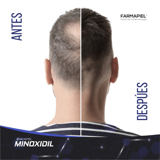 Anacastel Kit Anticaída Minoxidil 5% Morado Spray + Shampoo | Tratamiento Capilar para Frenar la Caída del Cabello | Estimula el Crecimiento del Cabello y Barba